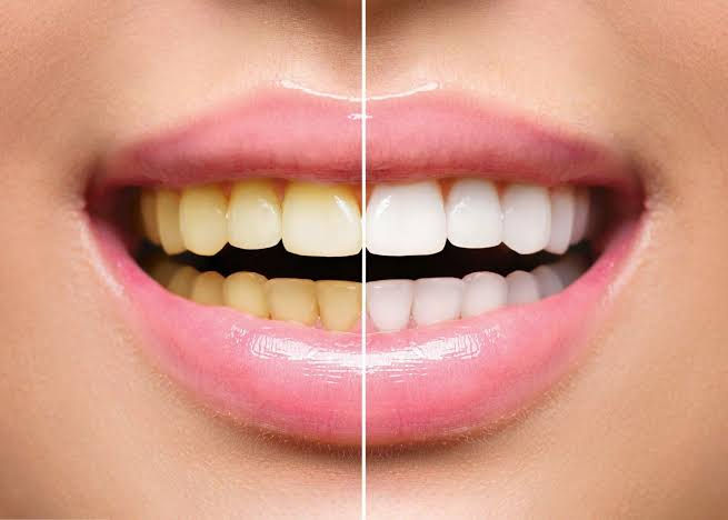पीले दांतों को सफेद बनाएगा यह एक पाउडर, जानिए घर पर इस Teeth Whitening Powder को बनाने का तरीका