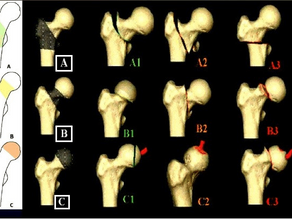Epidemiologia das fraturas do terço proximal do fêmur em pacientes idosos