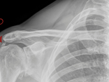 Calcificazione di Spalla: Sintomi, Cause e Trattamento
