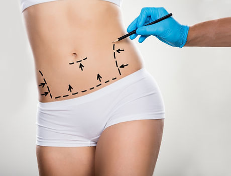Abdominoplastia