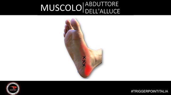trigger point abduttore dell'alluce.JPG
