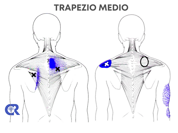 trigger point trapezio medio.png
