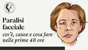 Paralisi facciale: cos'è, cause e cosa fare nelle prime 48 ore