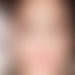 What can microdermabrasion do for you?