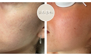 resulat avant-apres, amélioration qualité de peau joue laser fractionné non ablatif type FRAXEL, dr Berthier, Rouen