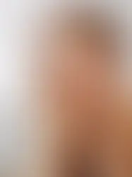 Mulher com skin picking ou transtorno de escoriação