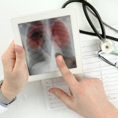 tromboembolia pulmonar.png