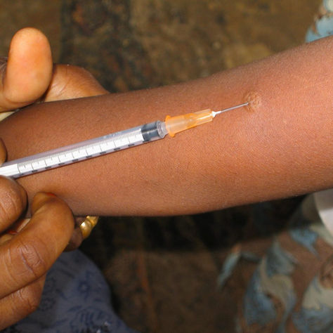 New study to evaluate Artificial Intelligence-assisted skin test for Tuberculosis prevention