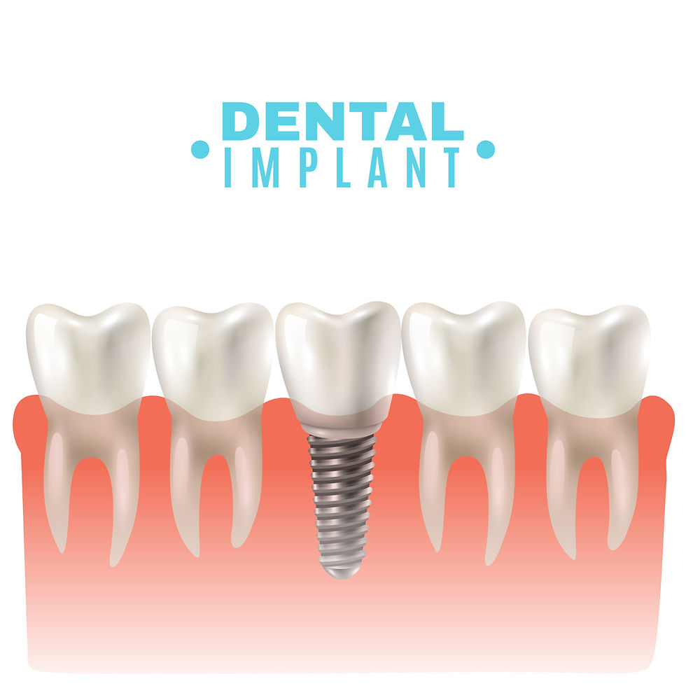 Dental implants