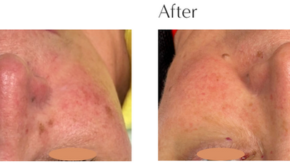 Foto Facial in Austin