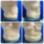 TruFlex Devenir Aesthetics actual patient