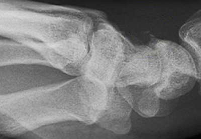 수부 X-ray (2).png