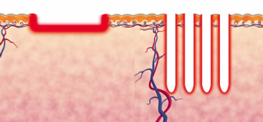 fractional-ablative-laser-treatment.png