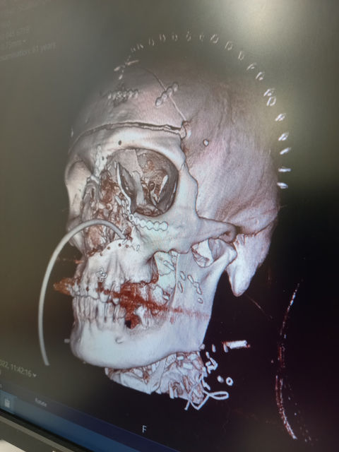 Pete Tolmies surgery