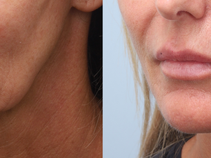 Sculptra in Auckland: natural results that grow with you