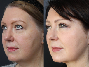 Natural-Looking Results from Mike Clague