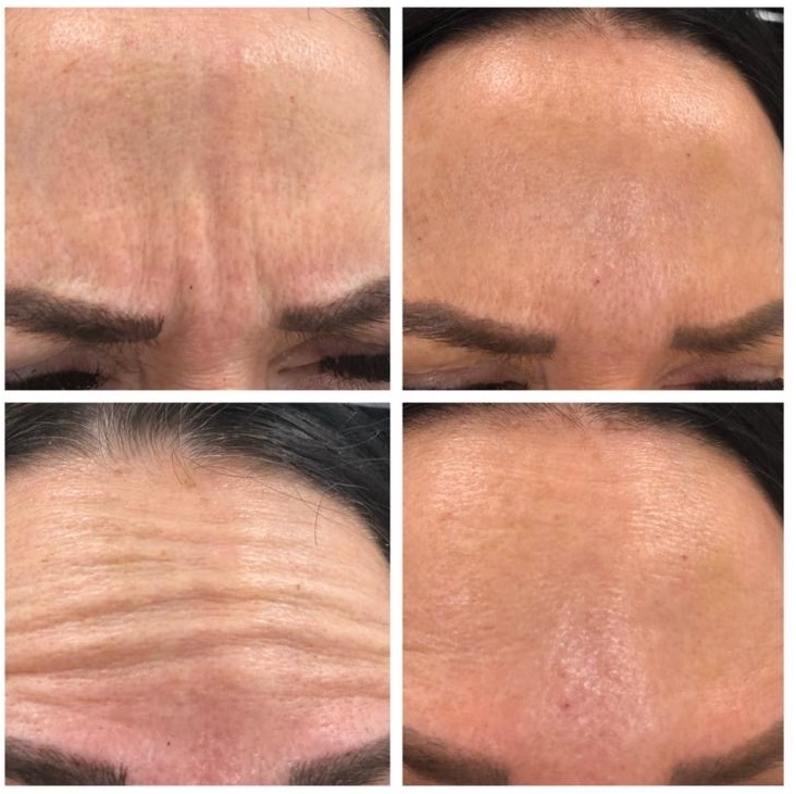 Anti-Wrinkle Treatment by Claire Ireland