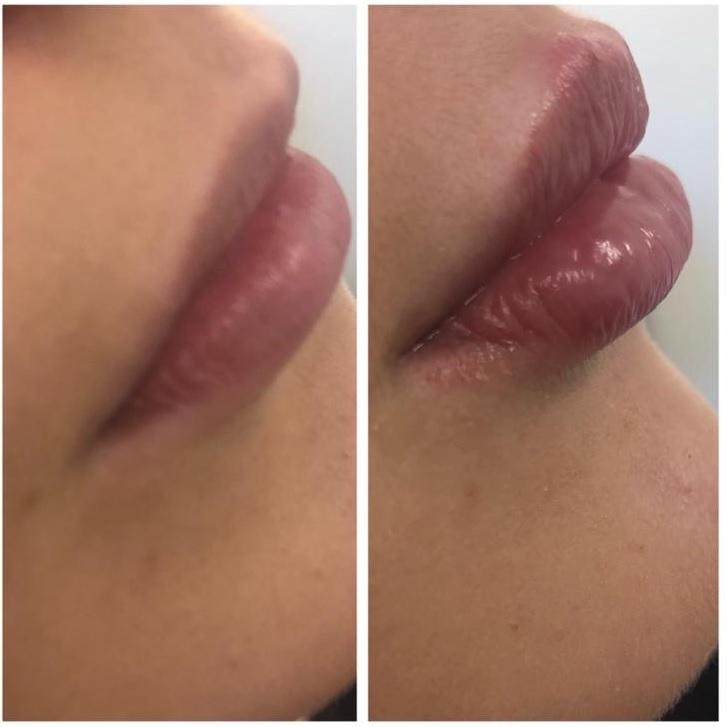 Lip augmentation by Claire Ireland