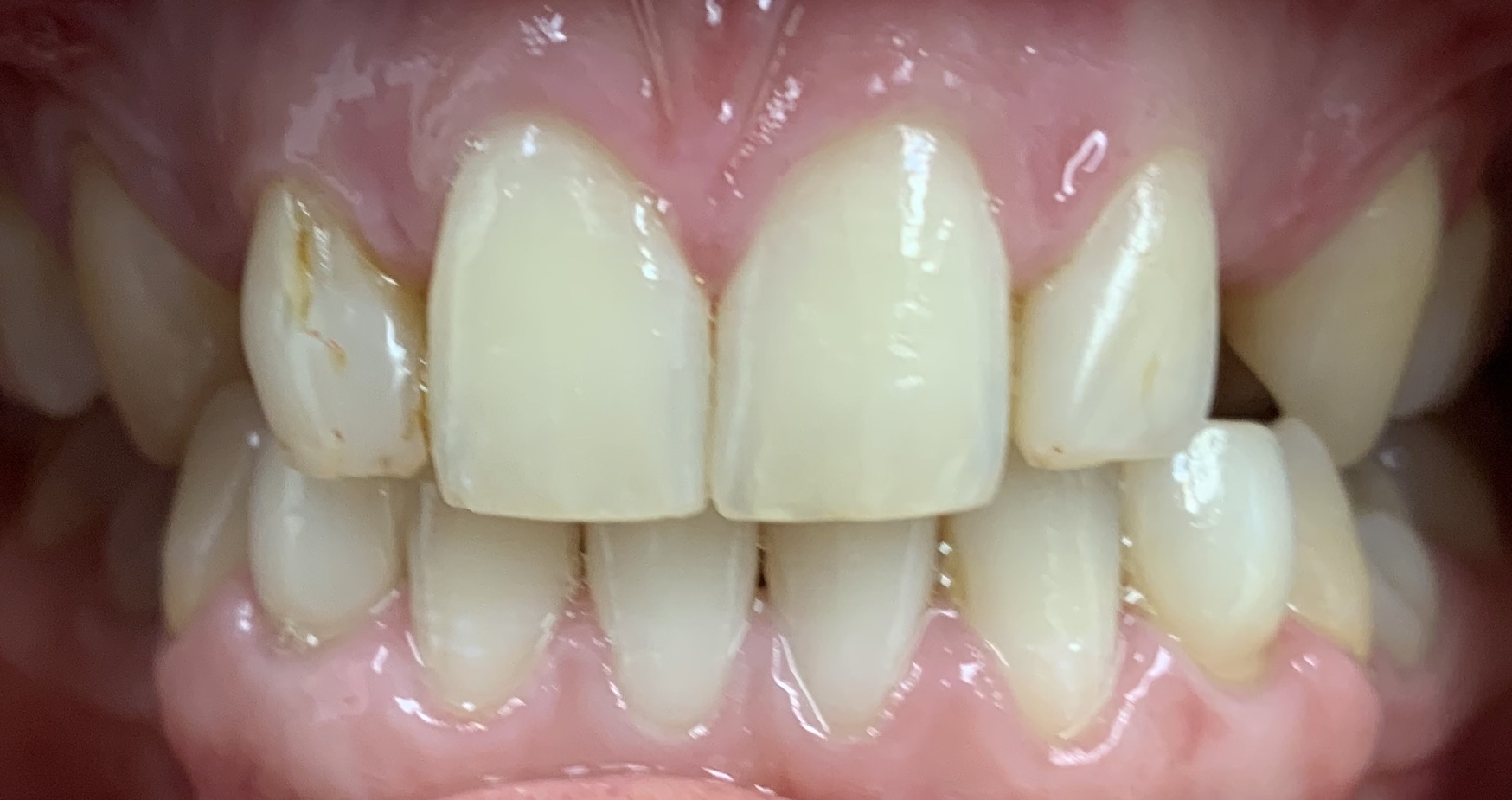 Missing spaces, stained old fillings.