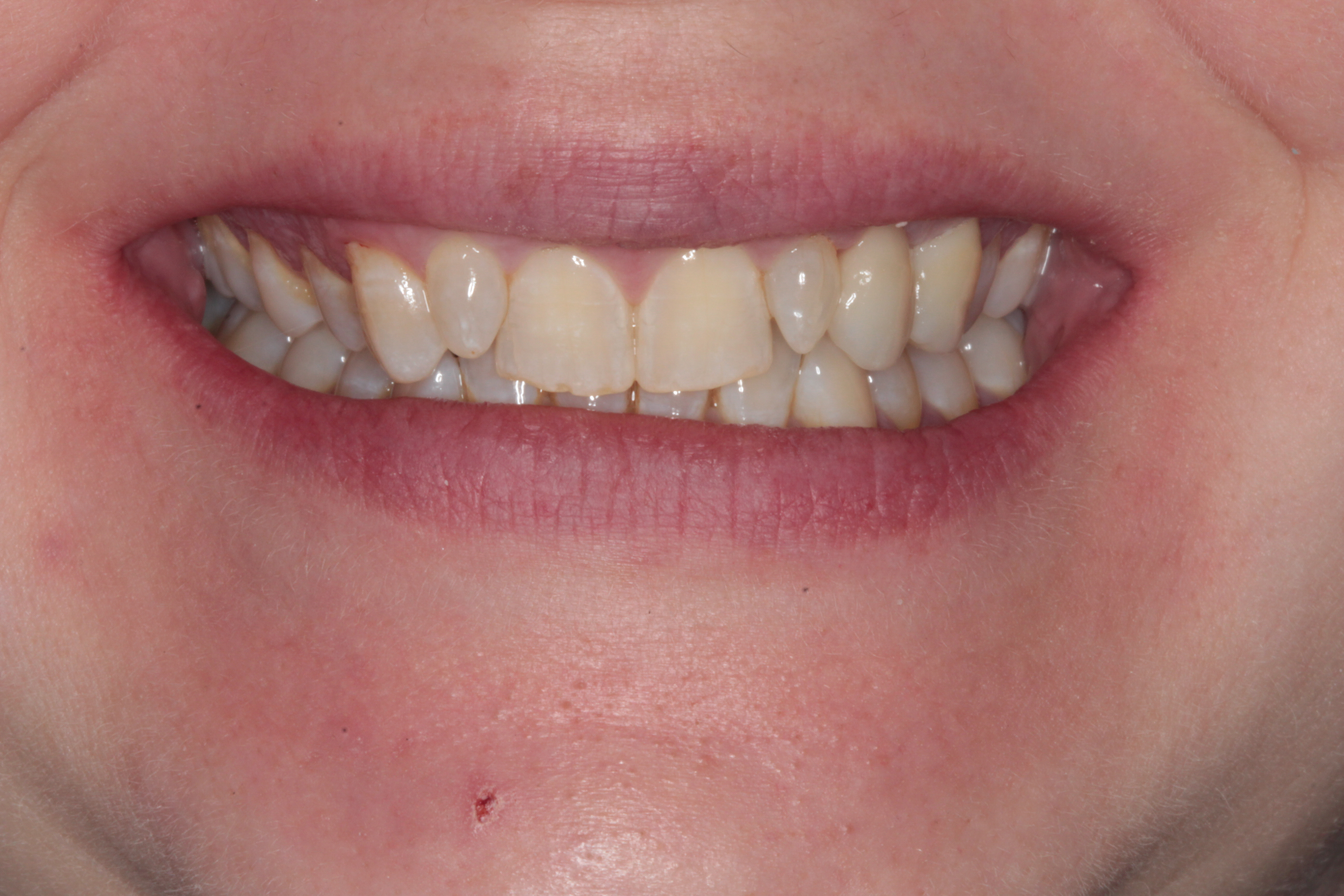Replacement with a natural looking porcelain bridge by Dr Robert Coveney