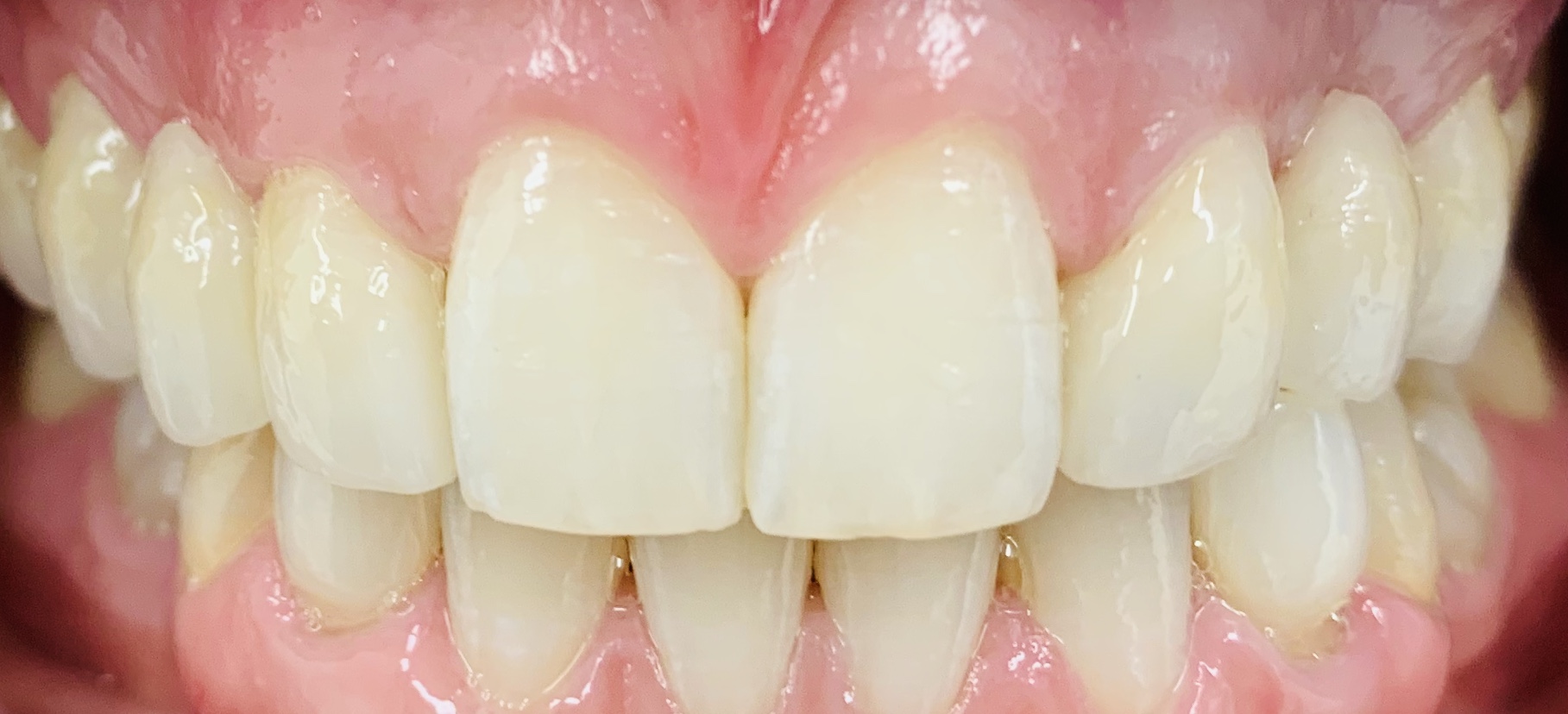 Whitening, composite bonding and bridgework by Dr Alistair McNeil
