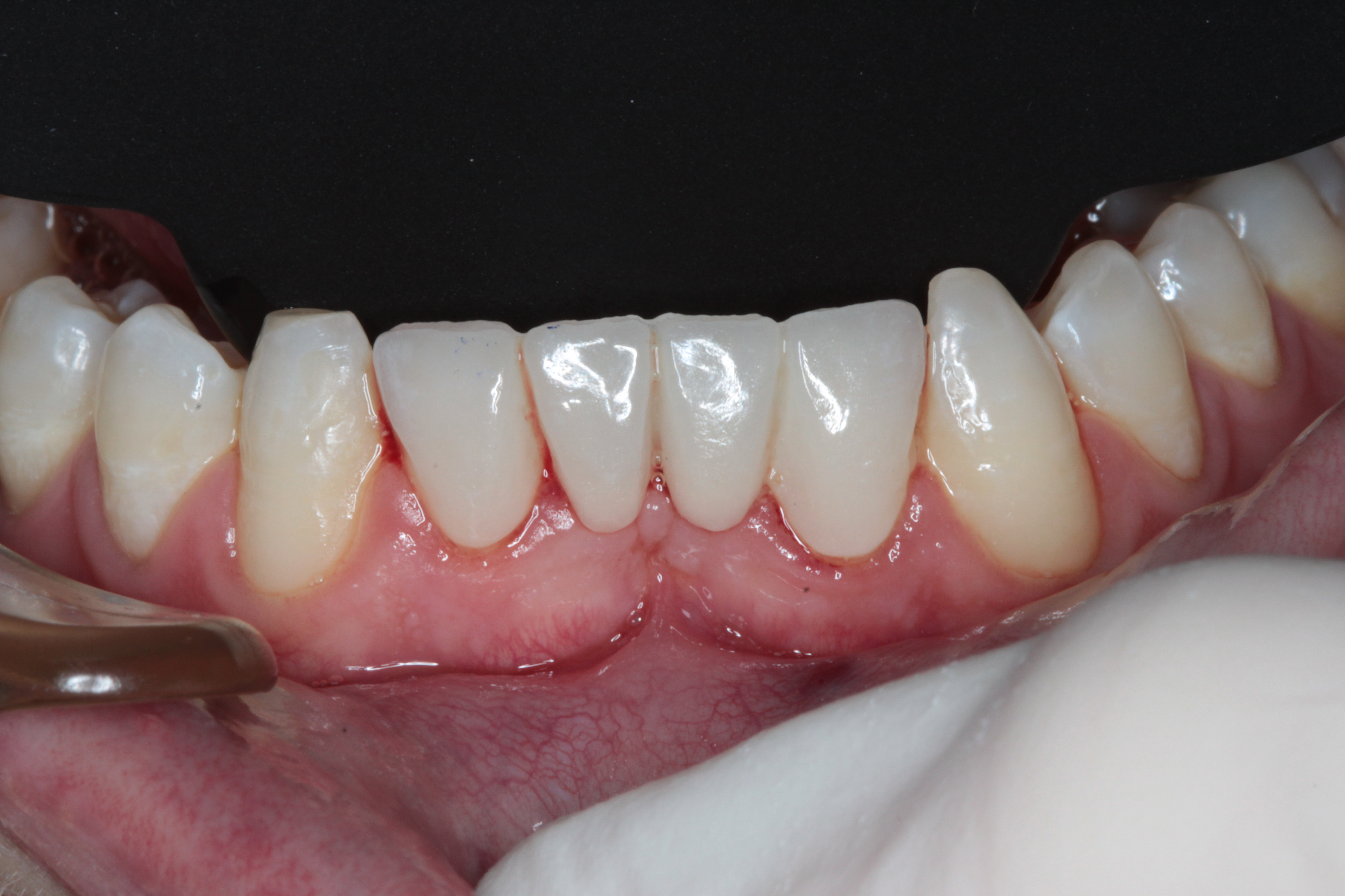 Bridge Replacement for All-Ceramic by Dr Robert Coveney
