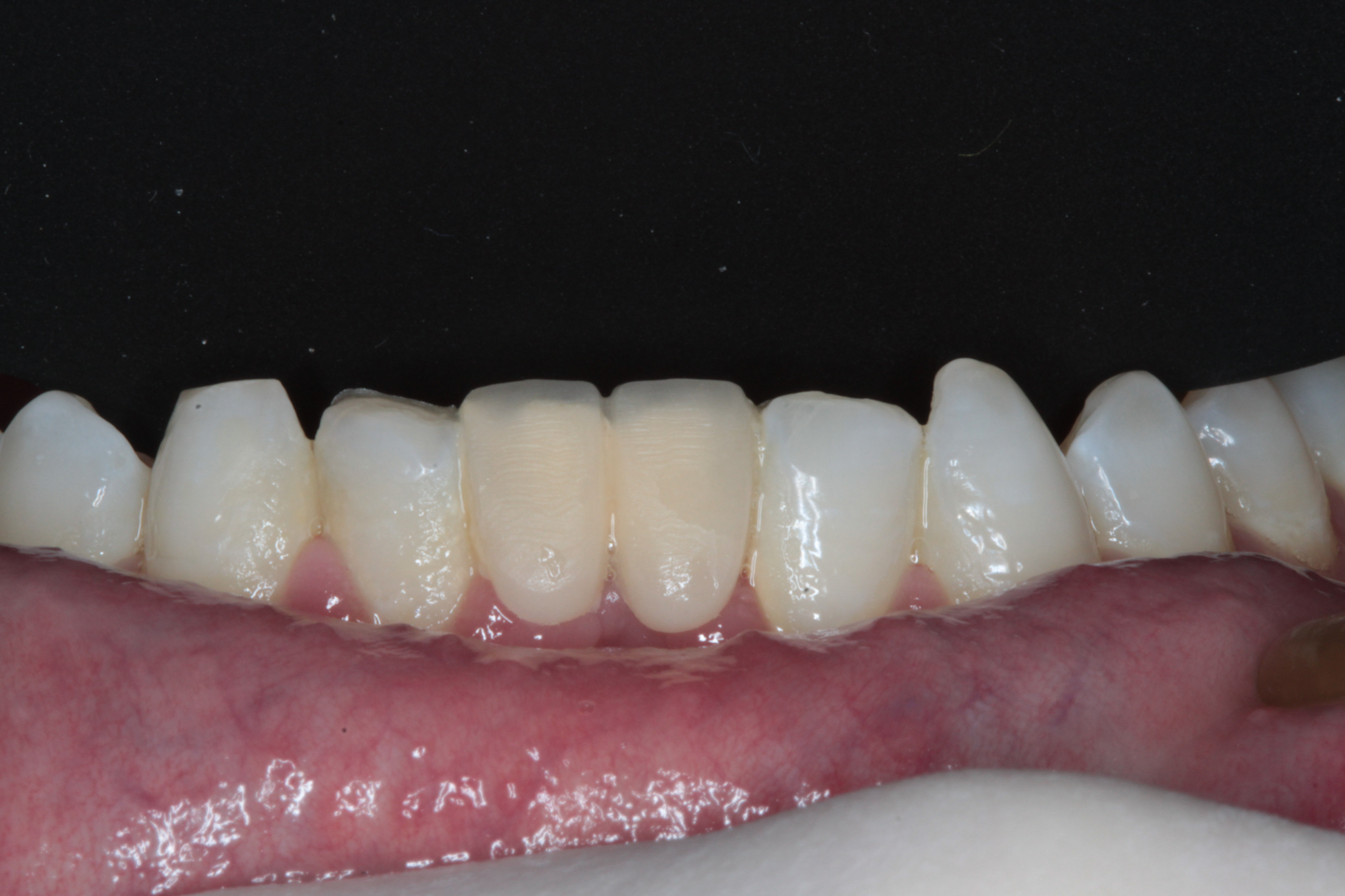 Old resin bonded bridge, poor colour match.