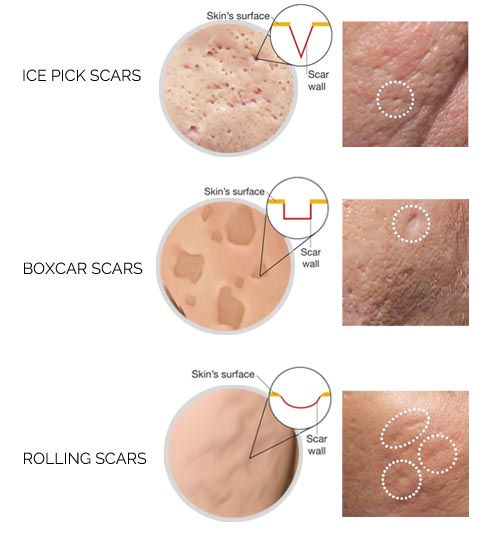 Scar Types