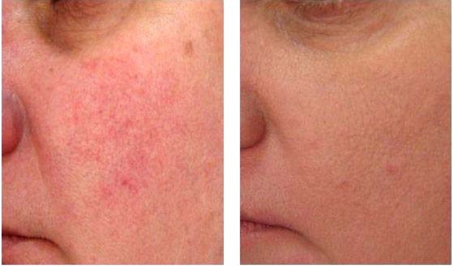 Rosacea Advanced Laser Clinic Sanctuary Lakes