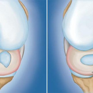 a knee meniscal tear
