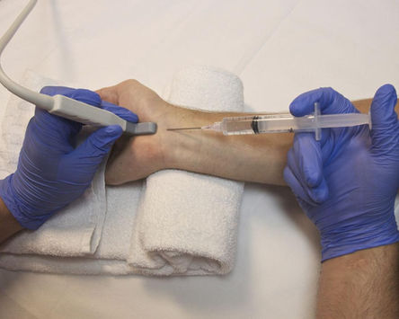 steroid injection to treat carpal tunnel syndrome