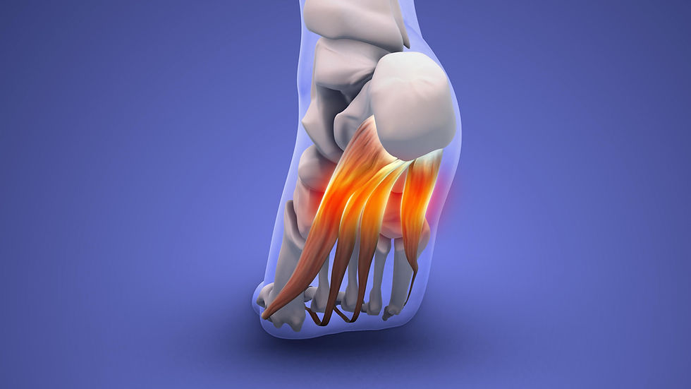 plantar fasciitis
