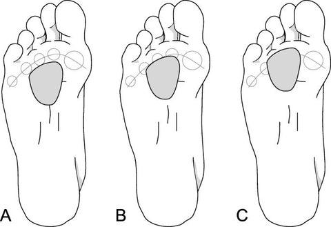image to show how padding helps for mortons neuroma