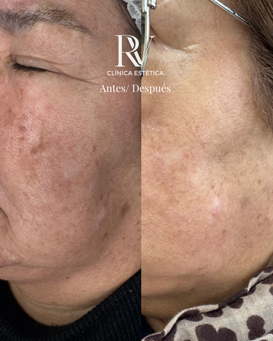 Tratamiento Láser q switch manchas clínica estética Concepción
