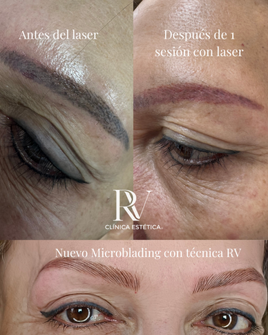 Despigmentación y microblading cejas clínica estética concepción