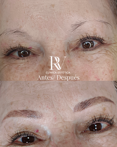Antes y después microblading cejas clínica estética RV Concepción