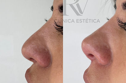 Antes y después tratamiento rinomodelación clínica estética RV Concepción