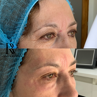 Antes y Después tratamiento Plasmage mirada cansada en Concepción