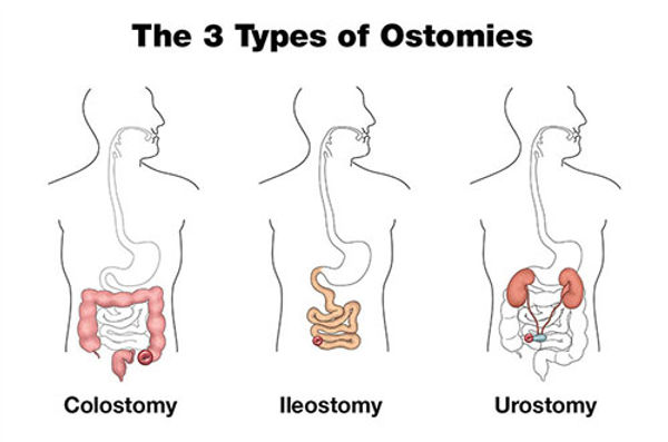 3 Types of Ostomies with Labels Blk_500x