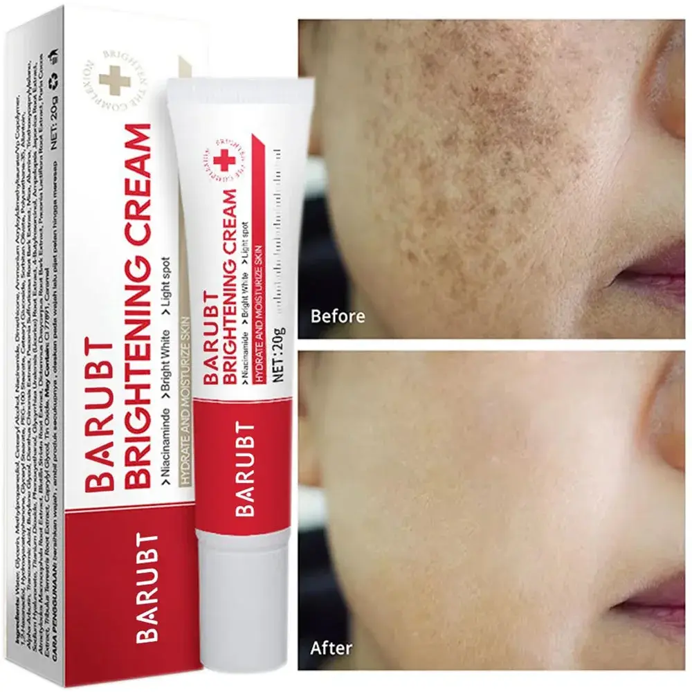 Whitening Freckles Face Cream Removal Melasma Dark Spots Corrector Lighten Melan