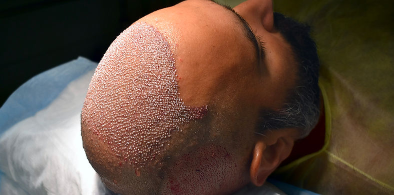 Inmediatamente después del trasplante de cabello