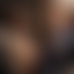 Hair loss in your 30s: Know the causes, treatment, tips to prevent premature balding