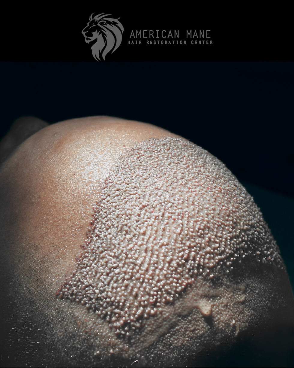 Why Experience Matters in Hair Restoration | Hair Transplant Experts in Miami & Aventura