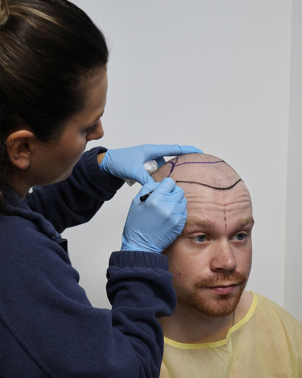 Why Manual FUE Gives More Natural-Looking Results | Hair Transplant Experts in Miami & Aventura