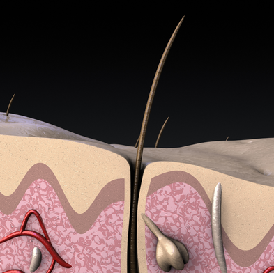 What is Verteporfin and how can be combined with hair transplants?