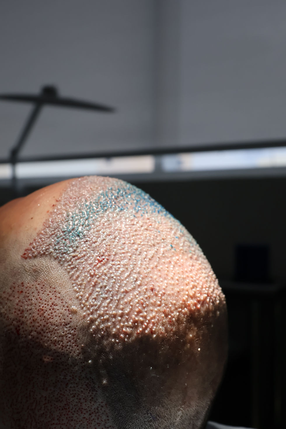 Why Manual FUE Can Create More Natural-Looking Hair Transplant Results | Hair Transplant Experts in Miami & Aventura