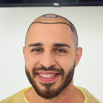 Hair Loss in Your 20s: What No One Tells You