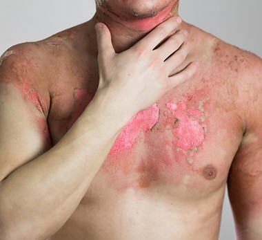 Man with a severe burn all over his body Close up Isolated on a gray background.jpg