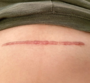 Cesarean section scar on woman belly.jpg