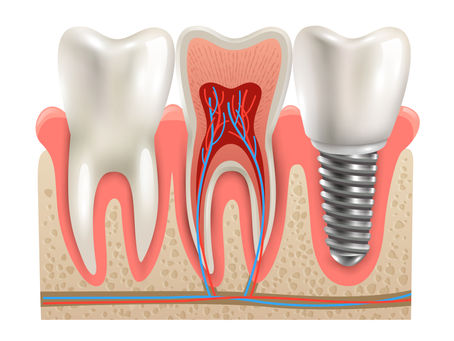 Root Canal Treatment
